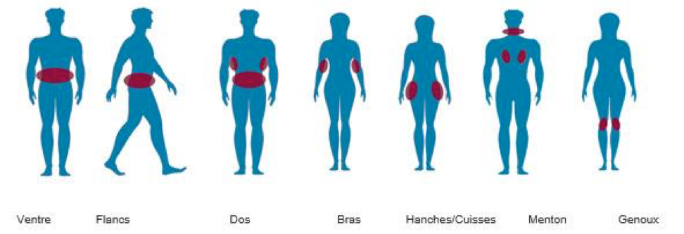 cryolipolyse-contraste-patient