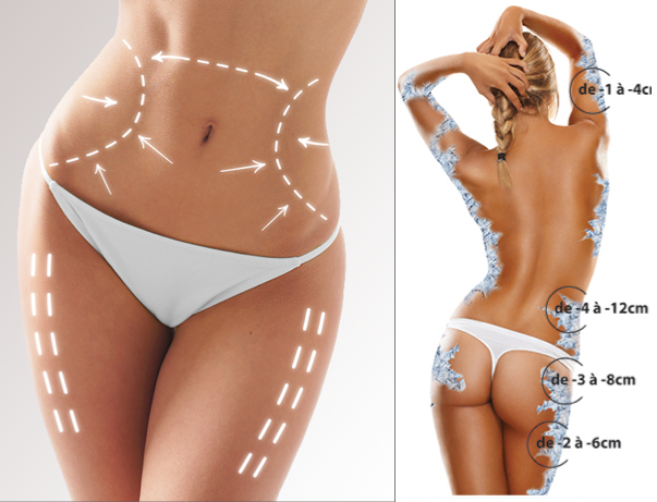 cryolipolyse-par-contraste